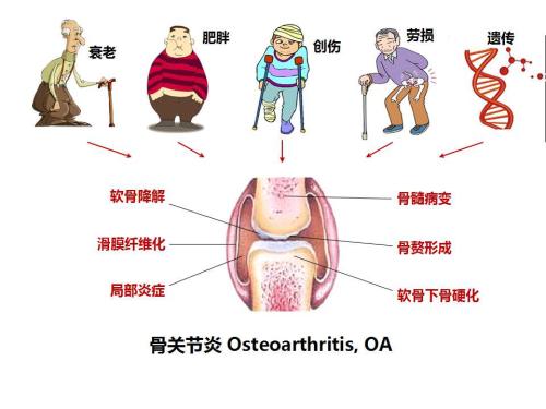 传岐弘医堂如何区分膝关节炎的类型教你正确的减痛锻炼方法这篇真相了