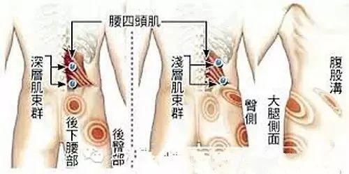 腰背肌和臀肌筋膜炎疼痛部位